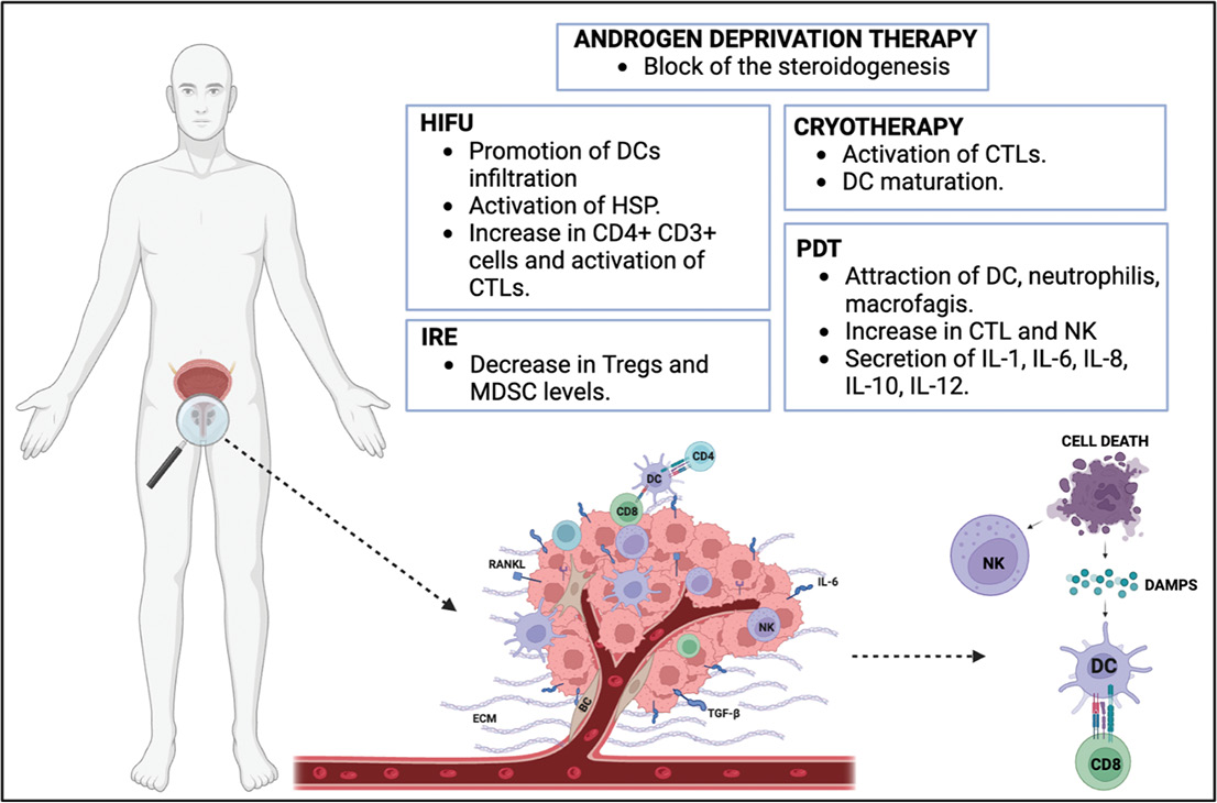 Focal Therapy The Role Of The Tumor Microenvironment In Prostate Cancer Focal Therapy American